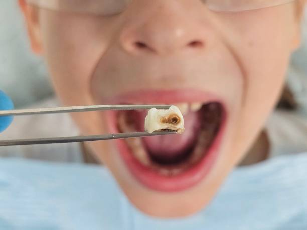 Best Emergency Treatment for Dental Infections or Abscesses in Honesdale, PA